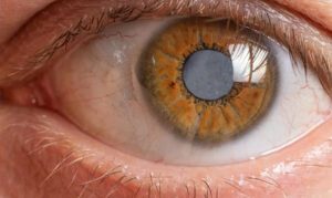 Eye with glaucoma